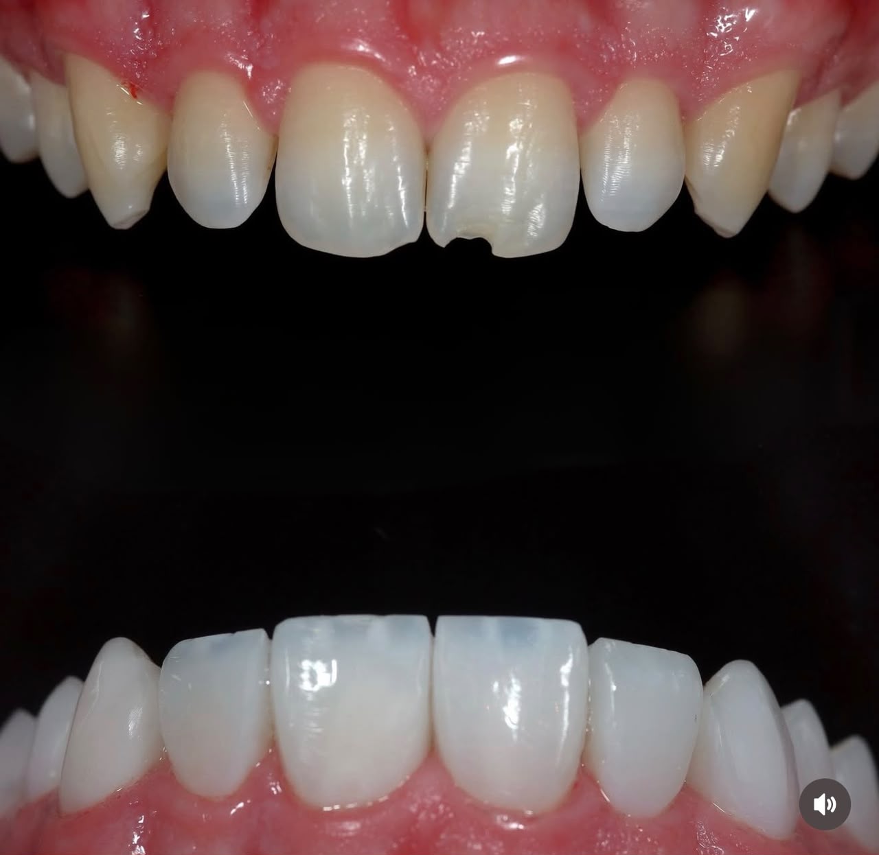 Detalhe de faceta em porcelana em paciente real da Sorrifácil Ingleses