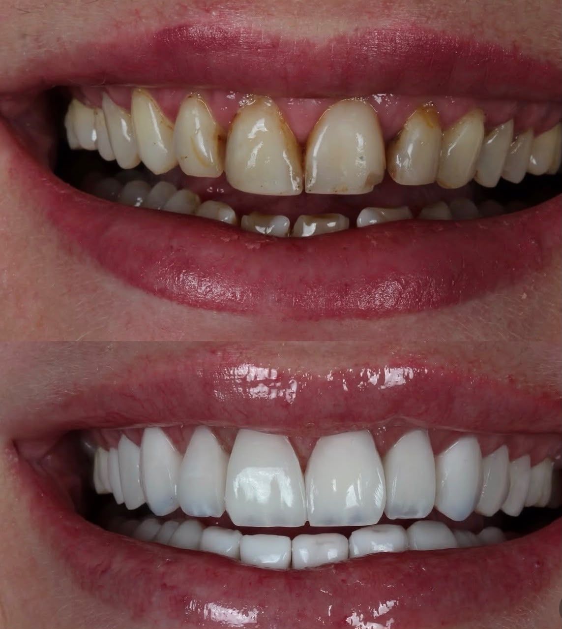 Caso · Lentes + clareamento — antes e depois