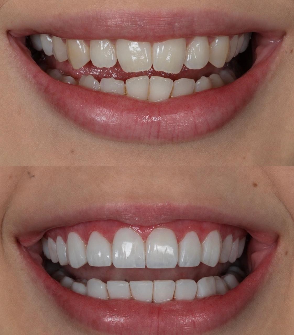 Caso · Lentes de porcelana — antes e depois